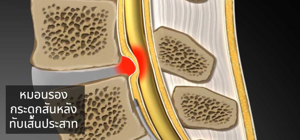 หมอนรองกระดูกปลิ้นทับเส้นประสาท
