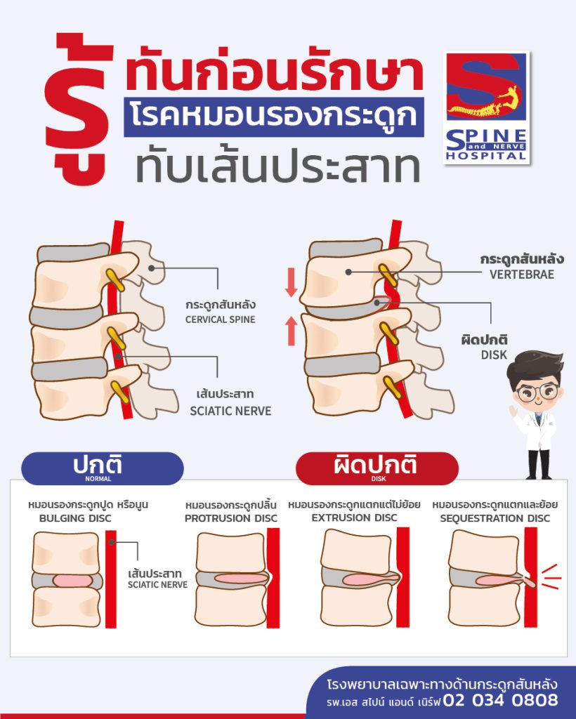 รู้ทันก่อนรักษาโรคหมอนรองกระดูกสันหบังทับเส้นประสาท