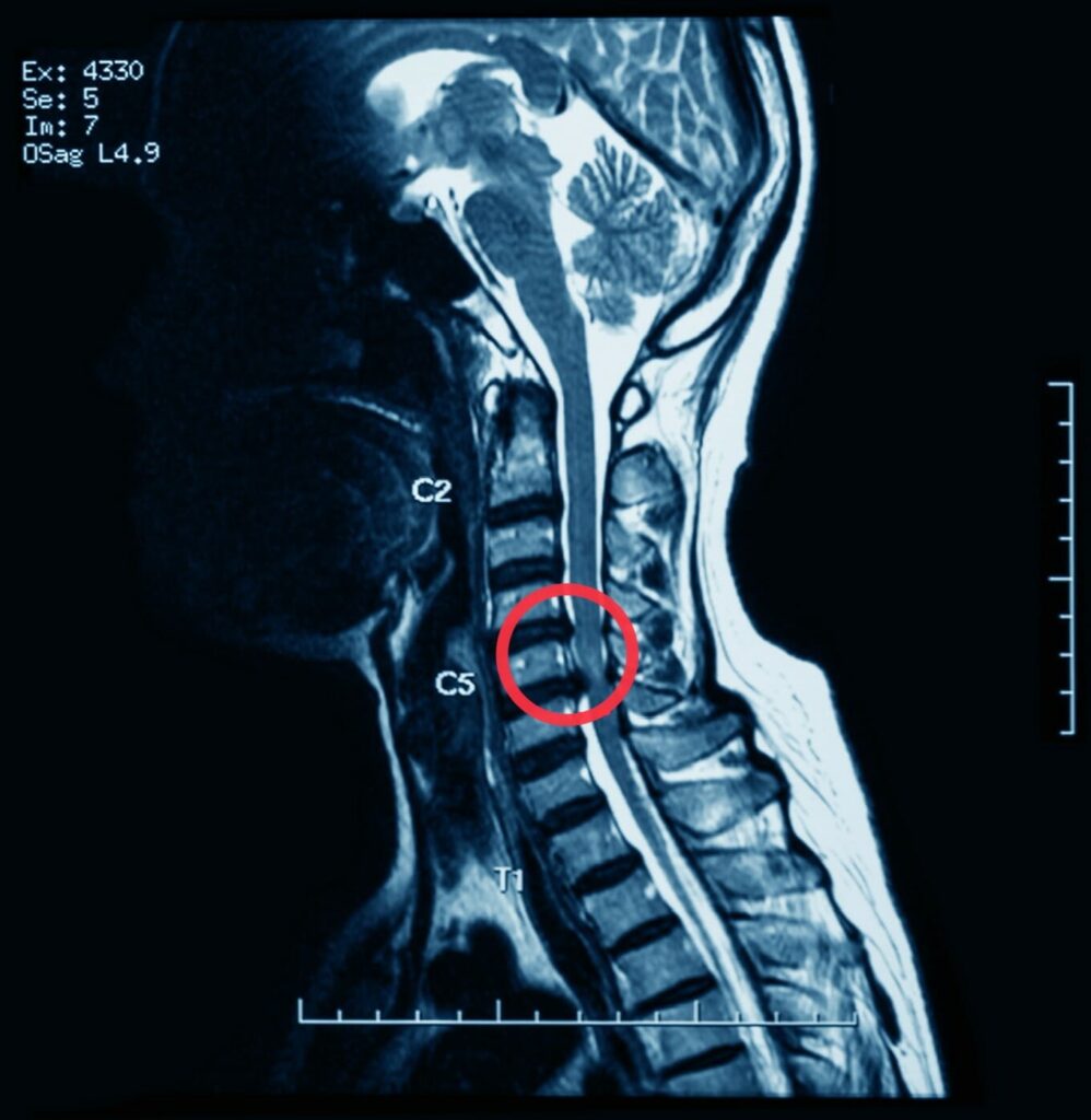 ภาพเปรียบเทียบ MRI หมอนรองกระดูกสันหลังส่วนคอ ก่อนและหลังผ่าตัด ด้วยเทคนิค PSCD