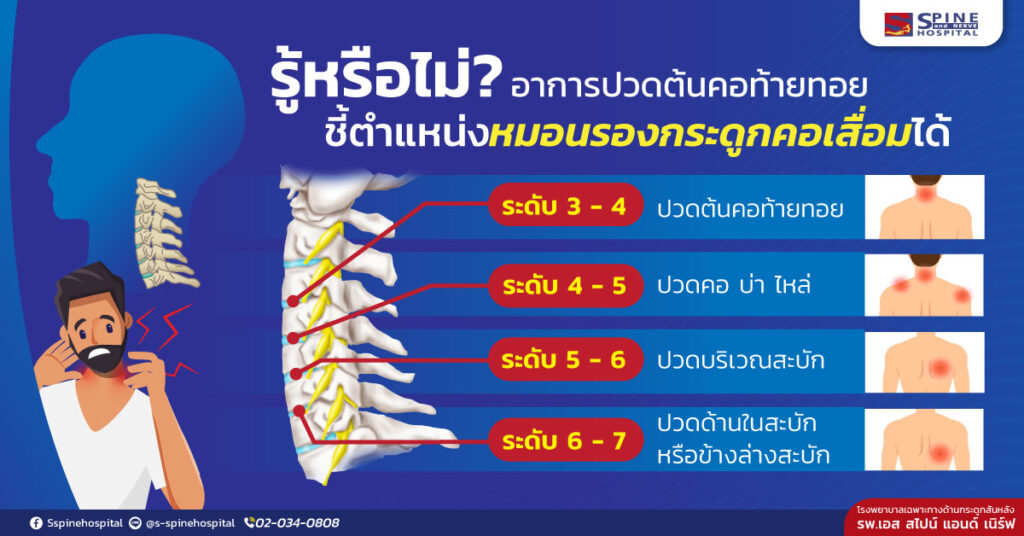 อาการปวดที่ต้นคอและท้ายทอย สามารถเป็นสัญญาณของหมอนรองกระดูกคอเสื่อม