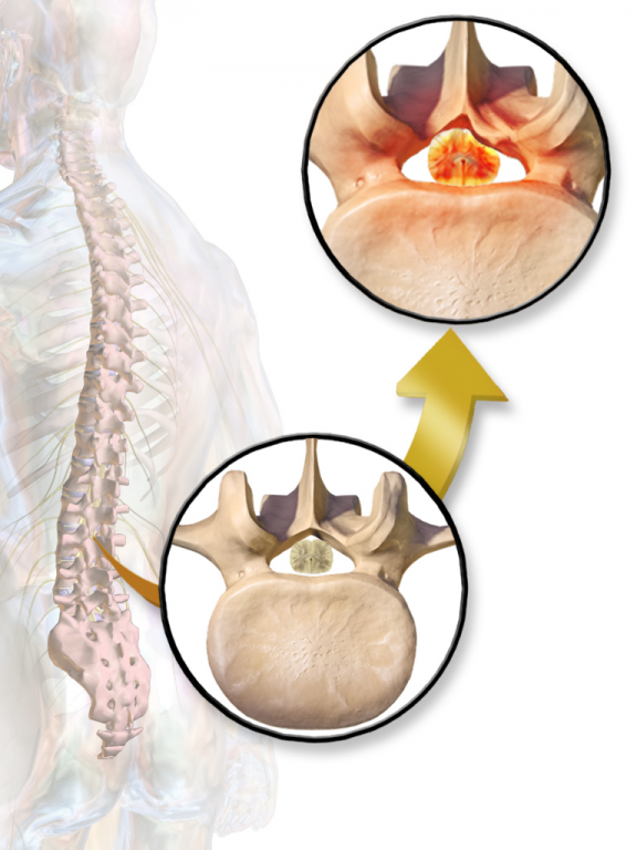 โพรงประสาทตีบแคบ (Lumber Spinal Stenosis)
