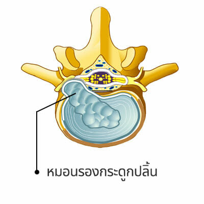 กลไกการเกิดหมอนรองกระดูกทับเส้นประสาท