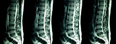 ภาพ MRI กระดูกสันหลัง