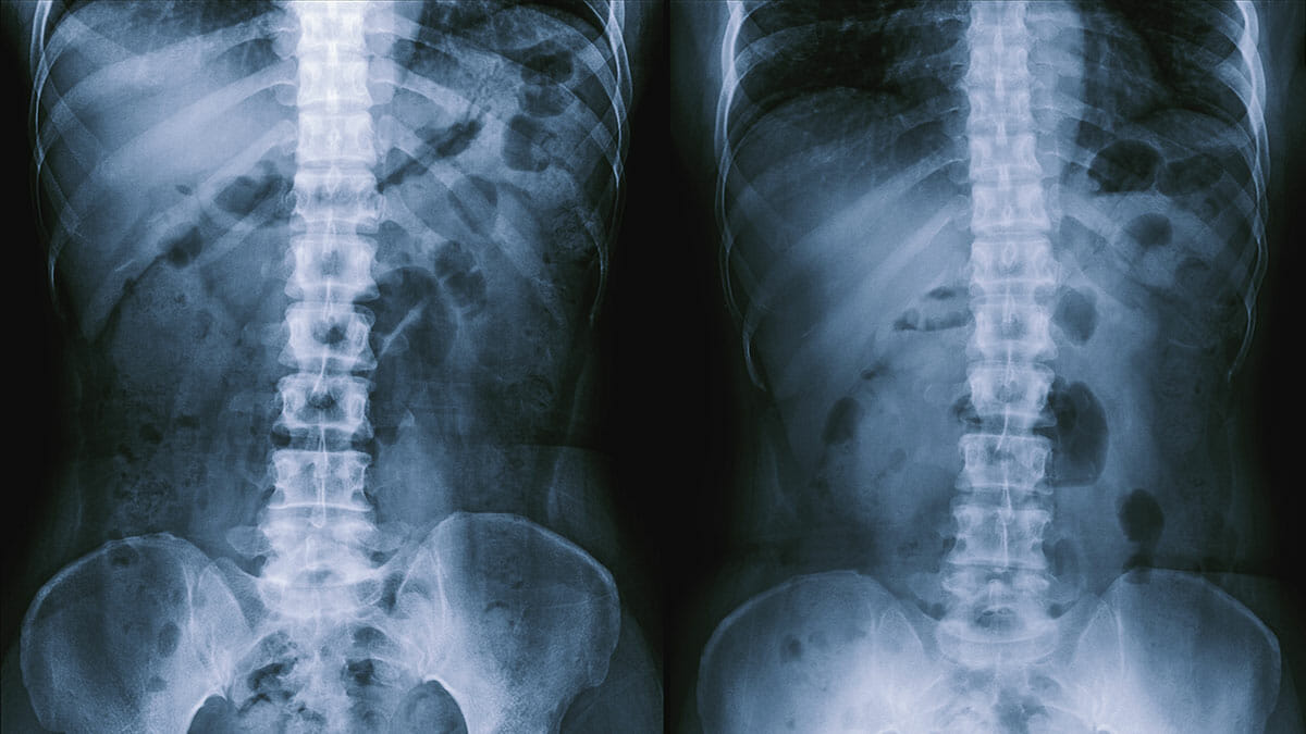 ภาพ X-ray กระดูกสันหลัง