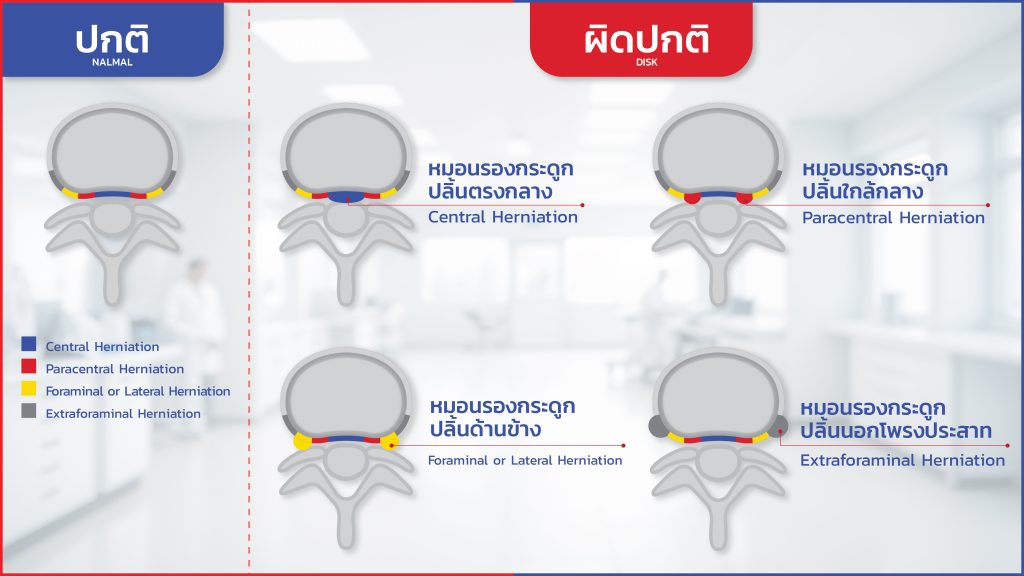 ภาพแสดงความแตกต่างระหว่างหมอนรองกระดูกสันหลังปกติและผิดปกติ โดยแสดงตำแหน่งการกดทับของหมอนรองกระดูกในลักษณะต่าง ๆ ได้แก่ Central Herniation, Paracentral Herniation, Foraminal or Lateral Herniation และ Extraforaminal Herniation ซึ่งอาจเป็นสาเหตุของอาการปวดหลังและปวดร้าวลงขา